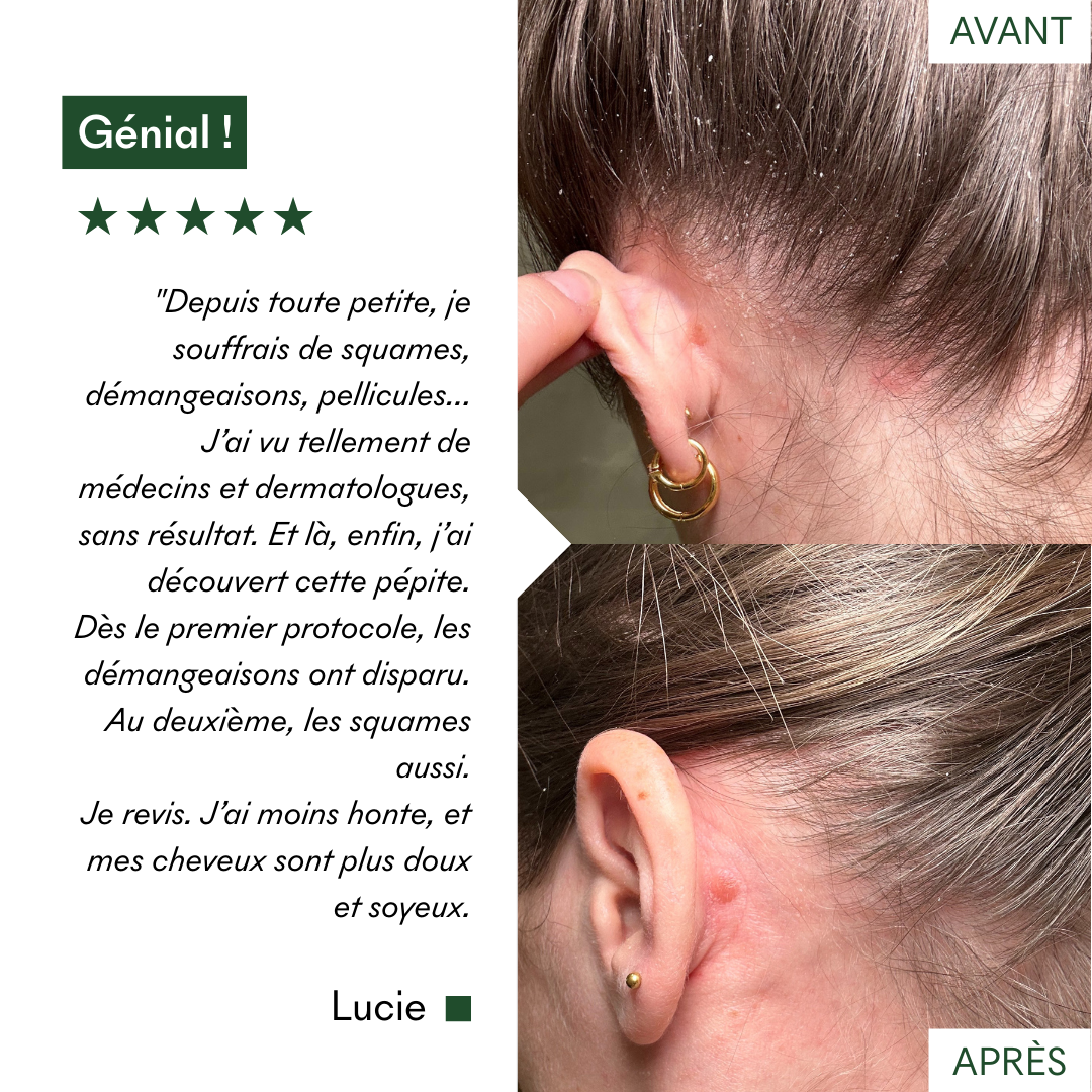 Complément SOS Squames Grasses