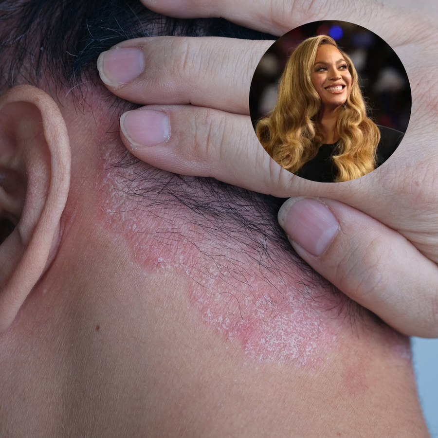 Beyoncé et le psoriasis du cuir chevelu : ce qu'il faut savoir