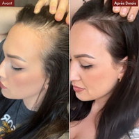 Anti-Haarausfall-Mikroinfusionspackung + gratis DHT