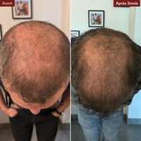 Anti-Haarausfall-Mikroinfusionspackung + gratis DHT