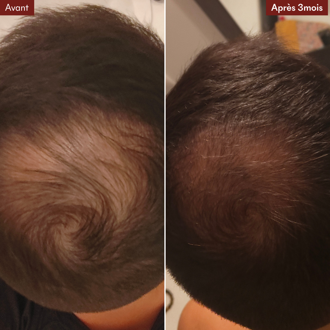 Anti-Haarausfall-Mikroinfusionspackung + gratis DHT