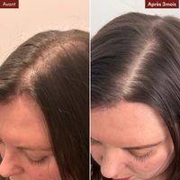 Anti-Haarausfall-Mikroinfusionspackung + gratis DHT