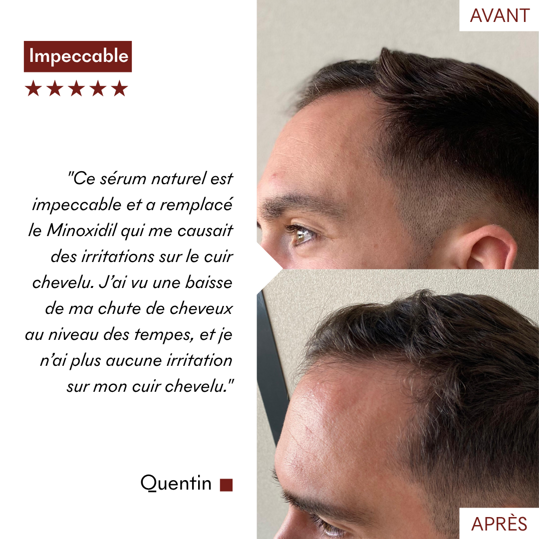 DHT Blocker Anti-Chute Hormonale 3 MOIS